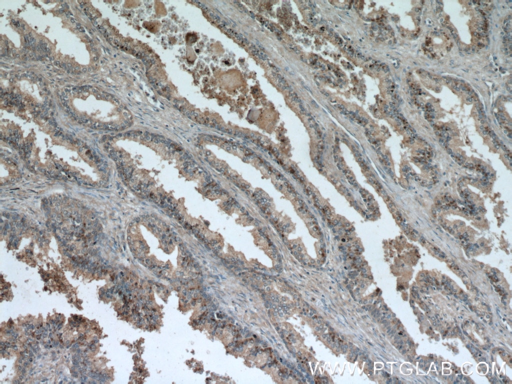 Immunohistochemistry (IHC) staining of human prostate hyperplasia tissue using BMP4 Polyclonal antibody (12492-1-AP)