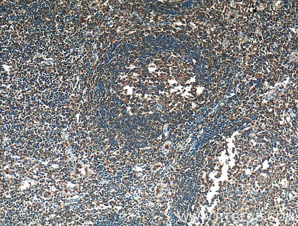 IHC staining of human tonsillitis using 55421-1-AP