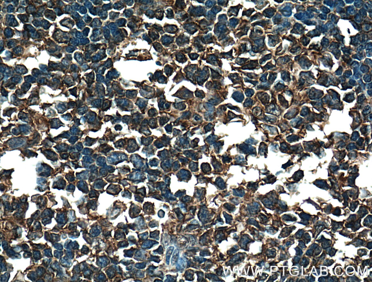 Immunohistochemistry (IHC) staining of human tonsillitis tissue using BMP6 Polyclonal antibody (55421-1-AP)