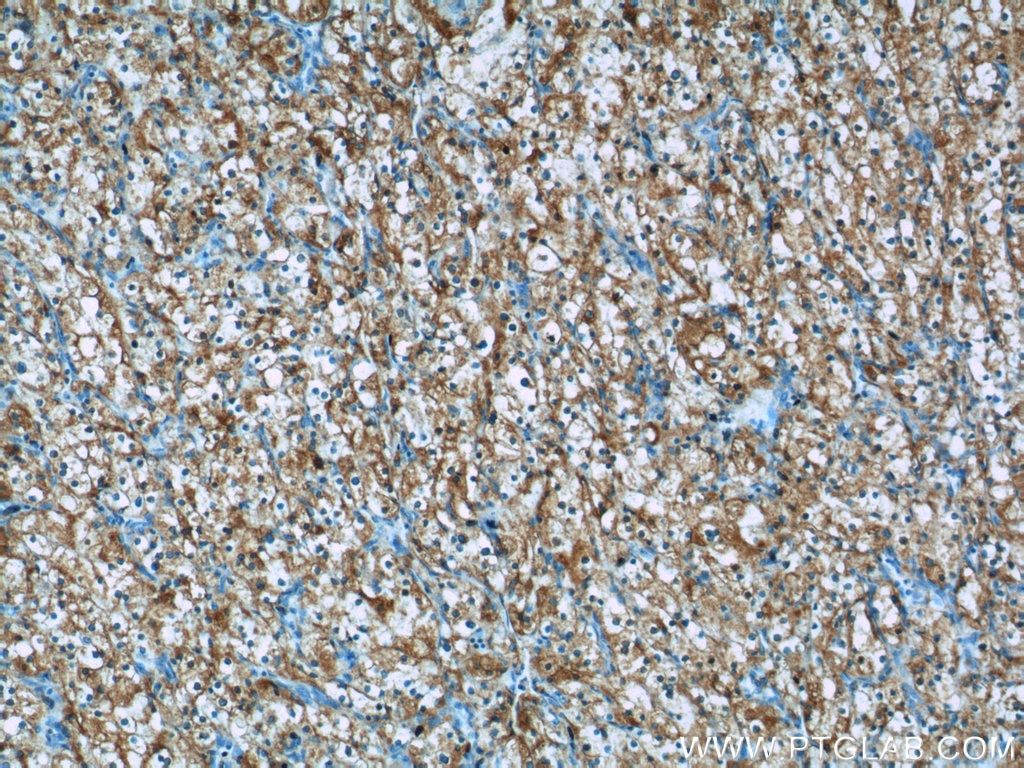 Immunohistochemistry (IHC) staining of human renal cell carcinoma tissue using BMP7 Polyclonal antibody (12221-1-AP)