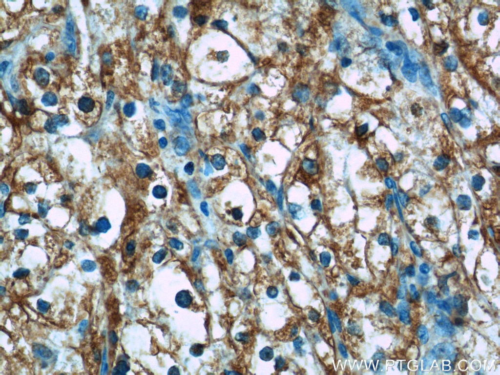 Immunohistochemistry (IHC) staining of human renal cell carcinoma tissue using BMP7 Polyclonal antibody (12221-1-AP)