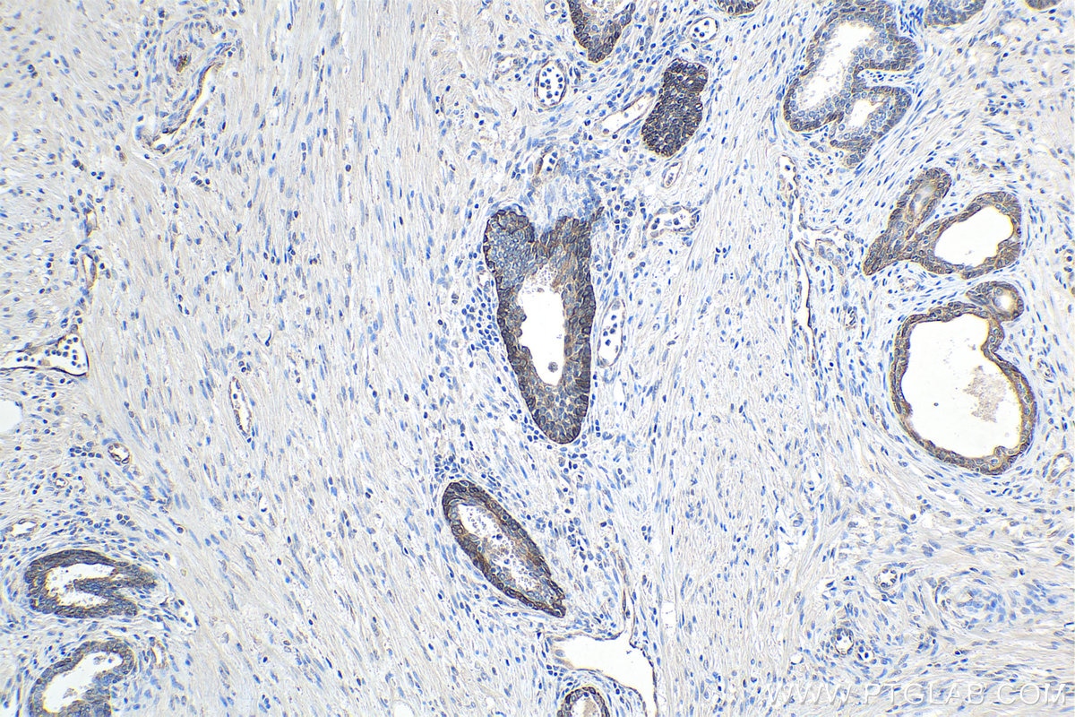 Immunohistochemistry (IHC) staining of human prostate cancer tissue using BNIP3L Monoclonal antibody (68118-1-Ig)