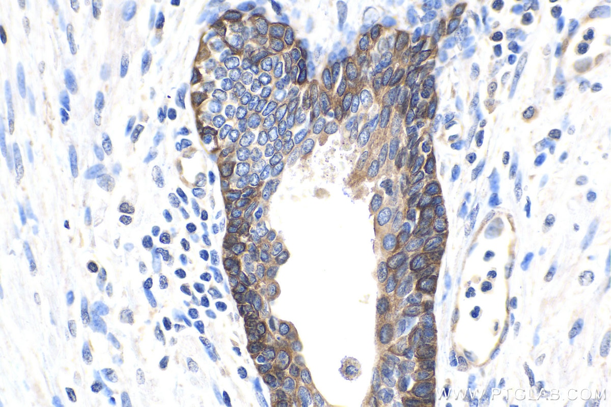 Immunohistochemistry (IHC) staining of human prostate cancer tissue using BNIP3L Monoclonal antibody (68118-1-Ig)