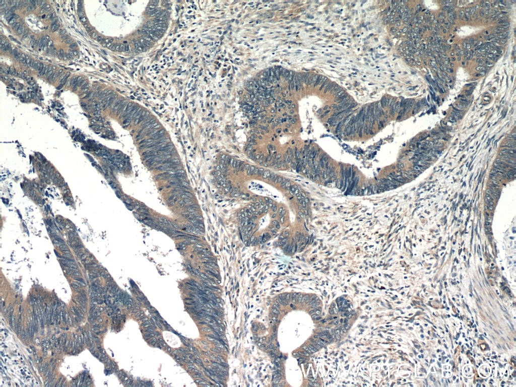 Immunohistochemistry (IHC) staining of human colon cancer tissue using BNIPL Polyclonal antibody (13262-1-AP)