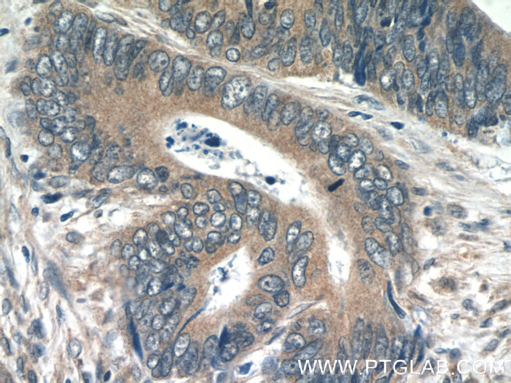 Immunohistochemistry (IHC) staining of human colon cancer tissue using BNIPL Polyclonal antibody (13262-1-AP)