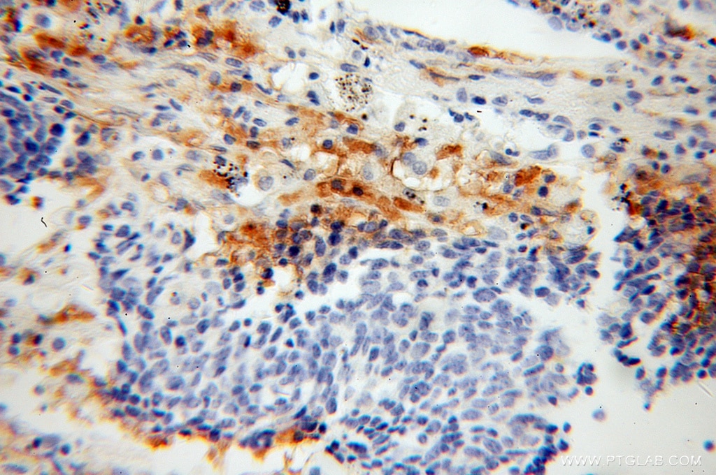 Immunohistochemistry (IHC) staining of human lung cancer tissue using BNIPL Polyclonal antibody (13262-1-AP)