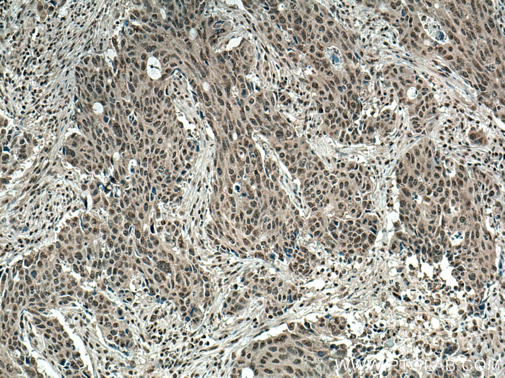 Immunohistochemistry (IHC) staining of human colon cancer tissue using BOP1 Polyclonal antibody (28366-1-AP)