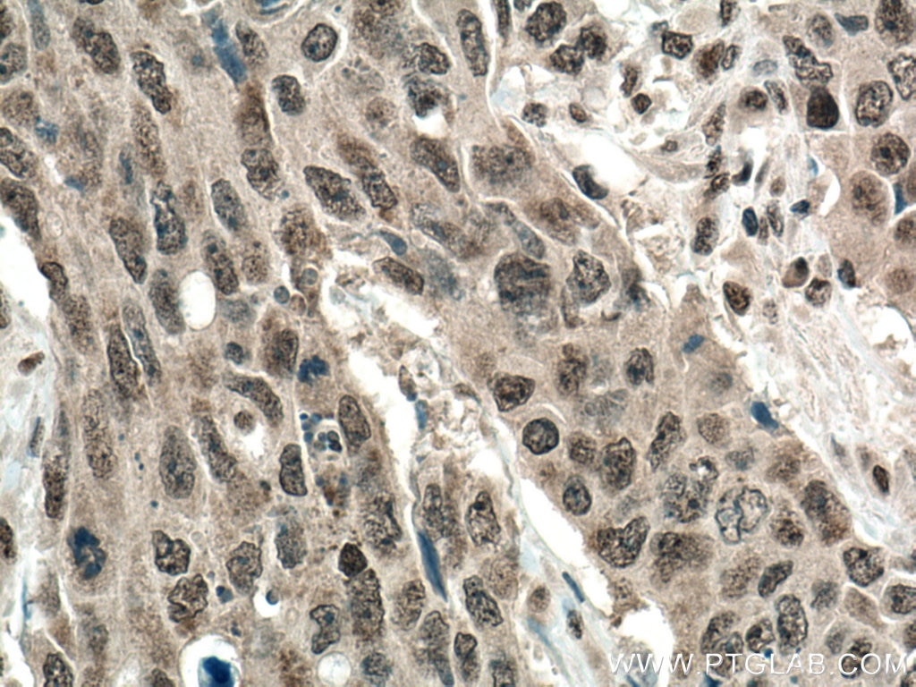Immunohistochemistry (IHC) staining of human colon cancer tissue using BOP1 Polyclonal antibody (28366-1-AP)