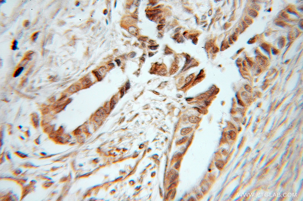 Immunohistochemistry (IHC) staining of human ovary tumor tissue using BORIS Polyclonal antibody (11074-2-AP)