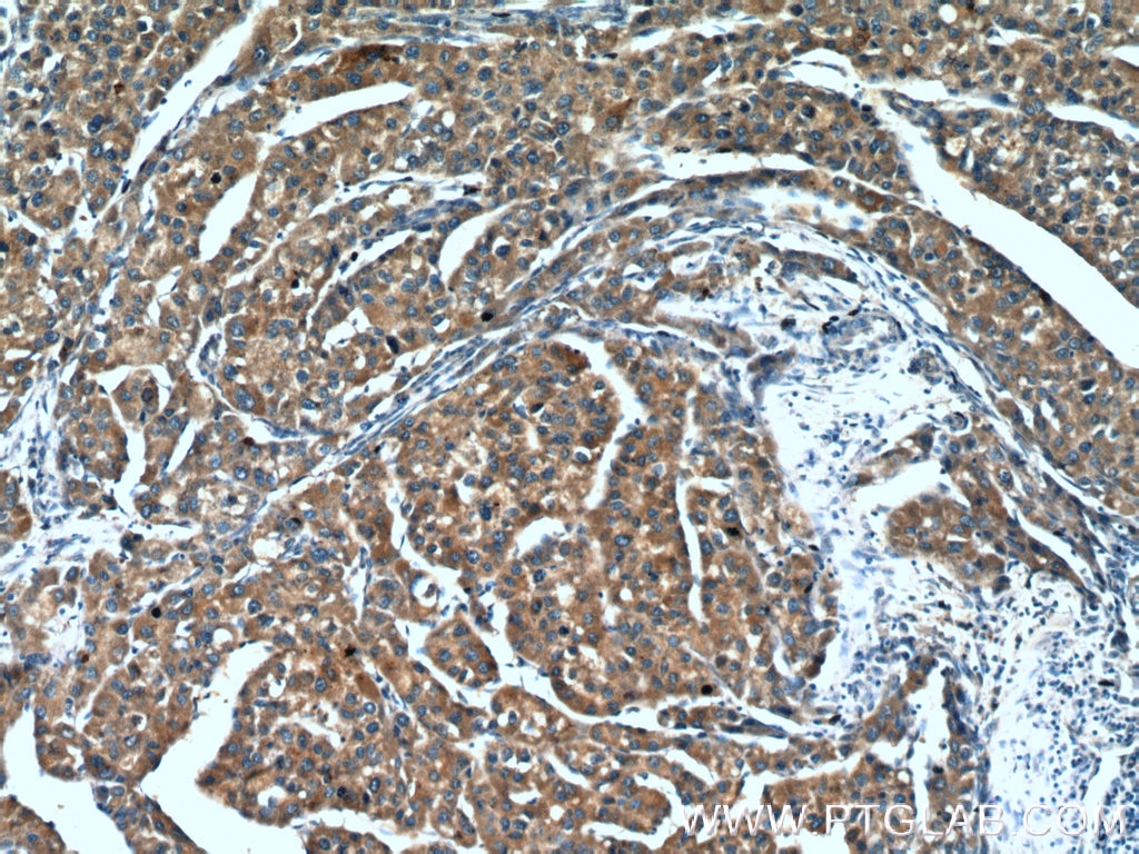 Immunohistochemistry (IHC) staining of human liver cancer tissue using BPGM Polyclonal antibody (17173-1-AP)