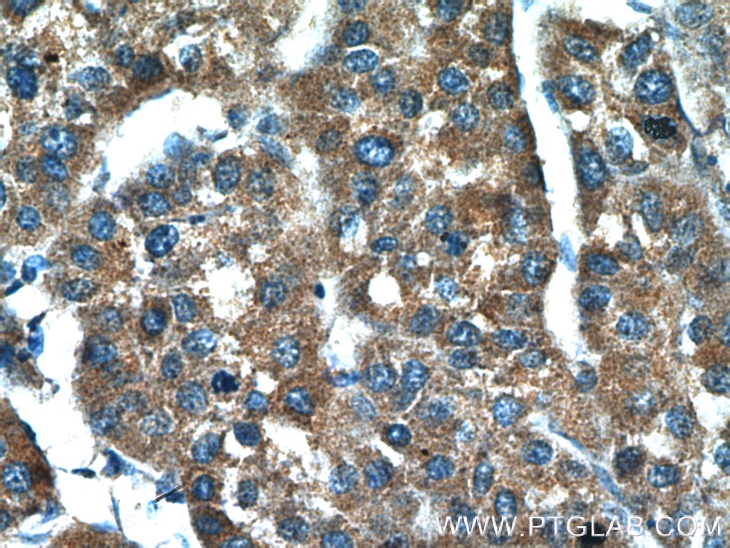 Immunohistochemistry (IHC) staining of human liver cancer tissue using BPGM Polyclonal antibody (17173-1-AP)