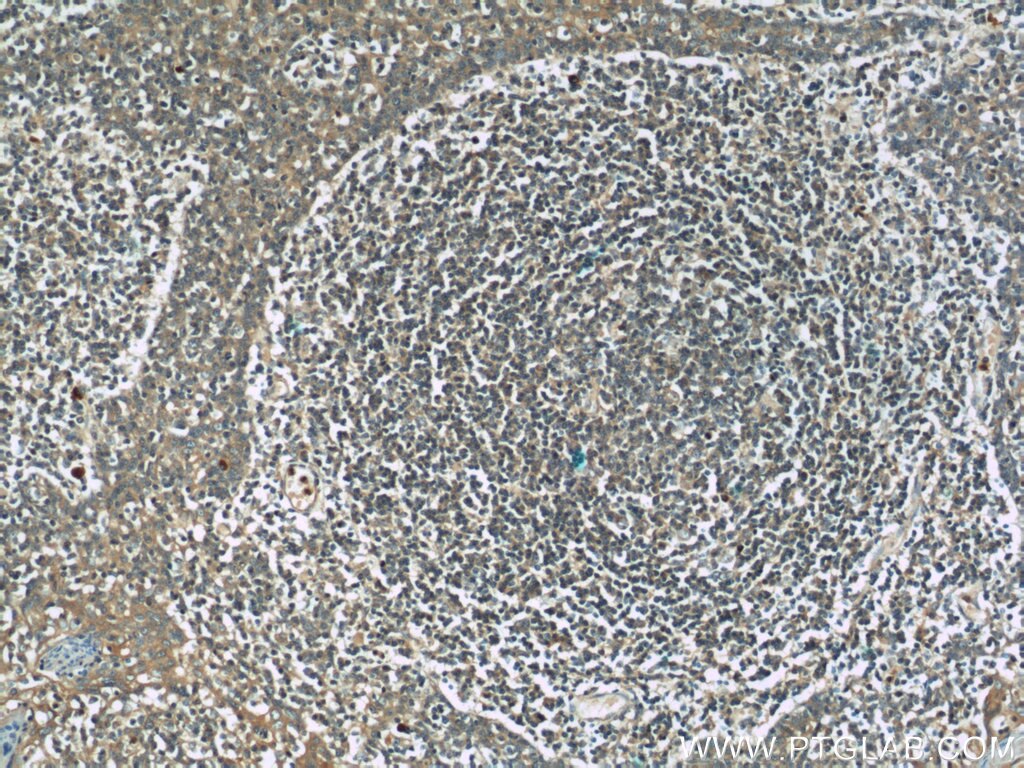 IHC staining of human tonsillitis using 13461-2-AP