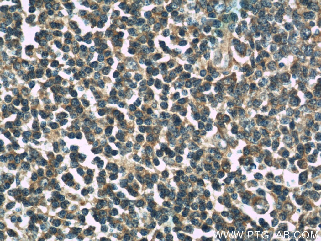 IHC staining of human tonsillitis using 13461-2-AP