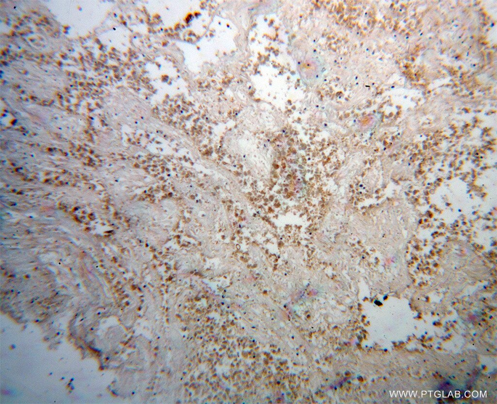 Immunohistochemistry (IHC) staining of human lung cancer tissue using BPIL1 Polyclonal antibody (13461-2-AP)