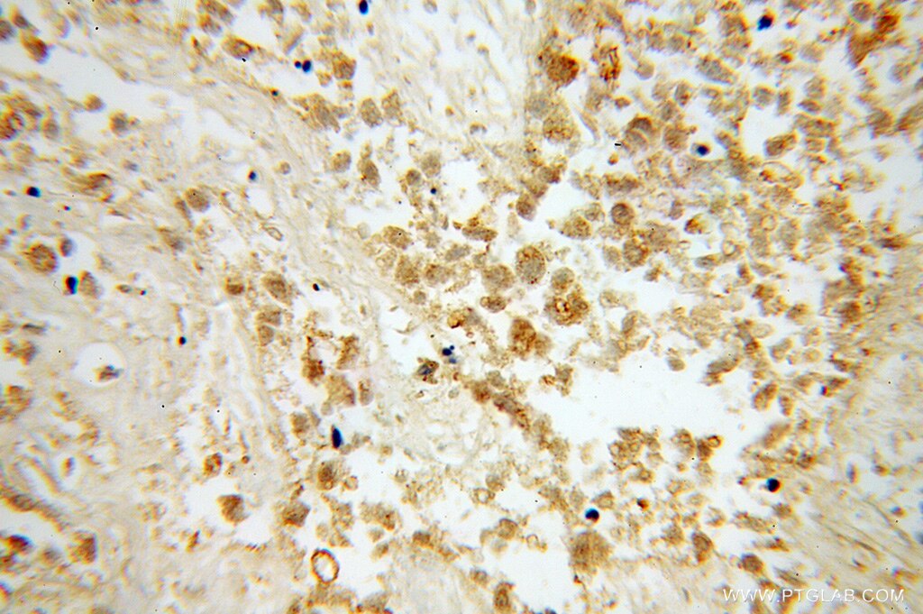 Immunohistochemistry (IHC) staining of human lung cancer tissue using BPIL1 Polyclonal antibody (13461-2-AP)