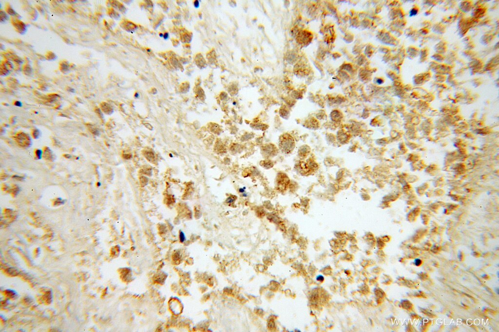 IHC staining of human lung cancer using 13461-2-AP