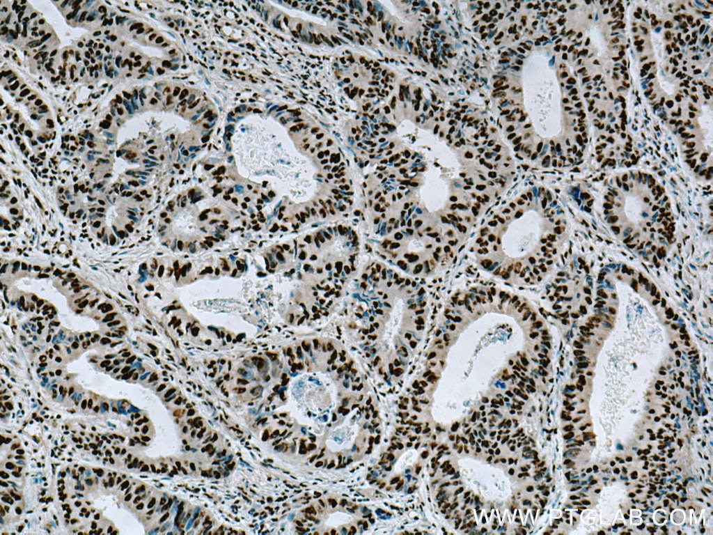 Immunohistochemistry (IHC) staining of human colon cancer tissue using BPTF Polyclonal antibody (28016-1-AP)