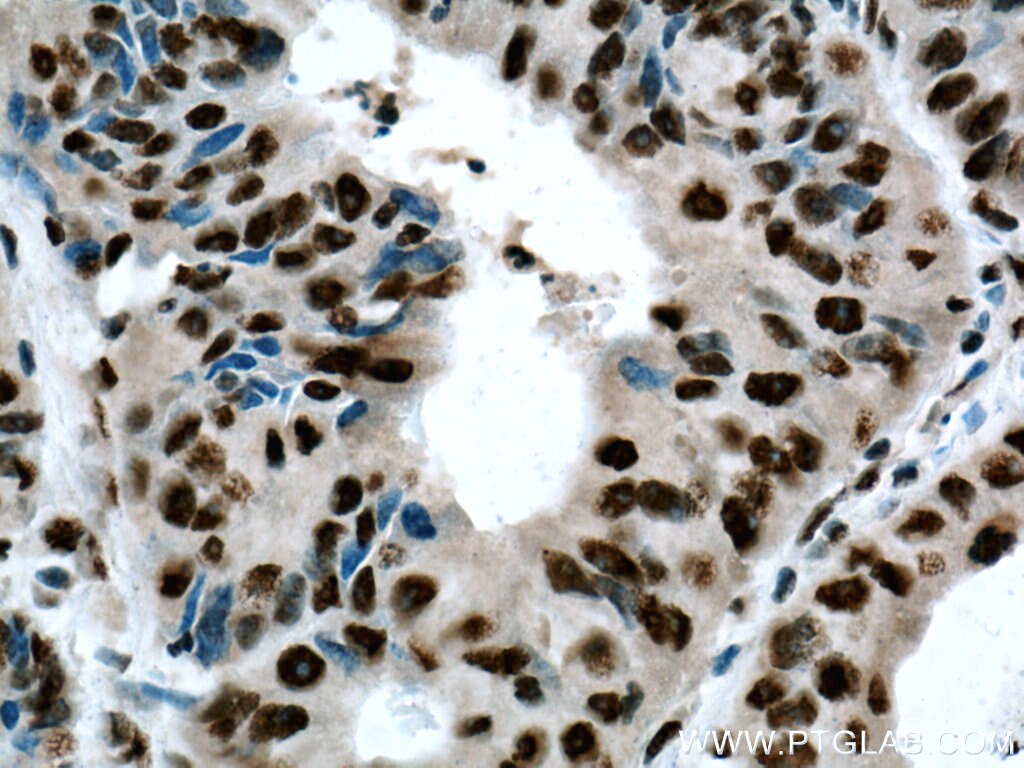 Immunohistochemistry (IHC) staining of human colon cancer tissue using BPTF Polyclonal antibody (28016-1-AP)