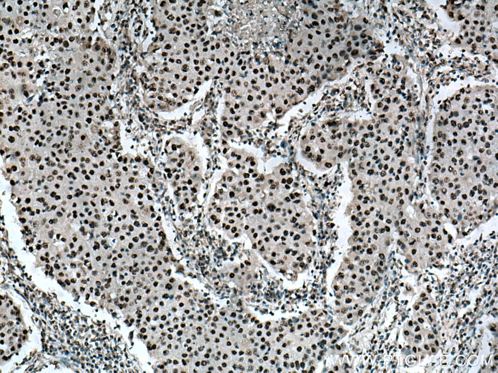 Immunohistochemistry (IHC) staining of human breast cancer tissue using BPTF Polyclonal antibody (28016-1-AP)