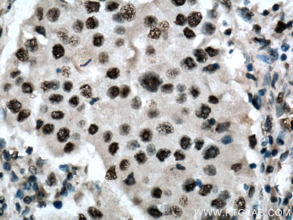 Immunohistochemistry (IHC) staining of human breast cancer tissue using BPTF Polyclonal antibody (28016-1-AP)