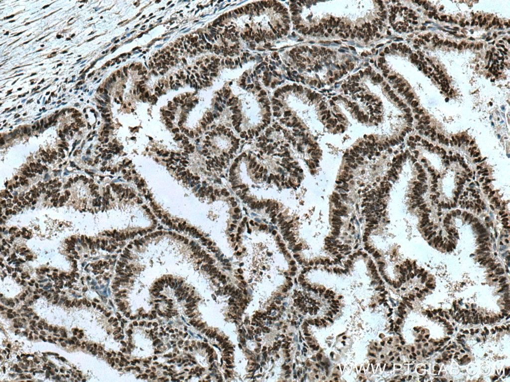 Immunohistochemistry (IHC) staining of human ovary tumor tissue using BPTF Polyclonal antibody (28016-1-AP)