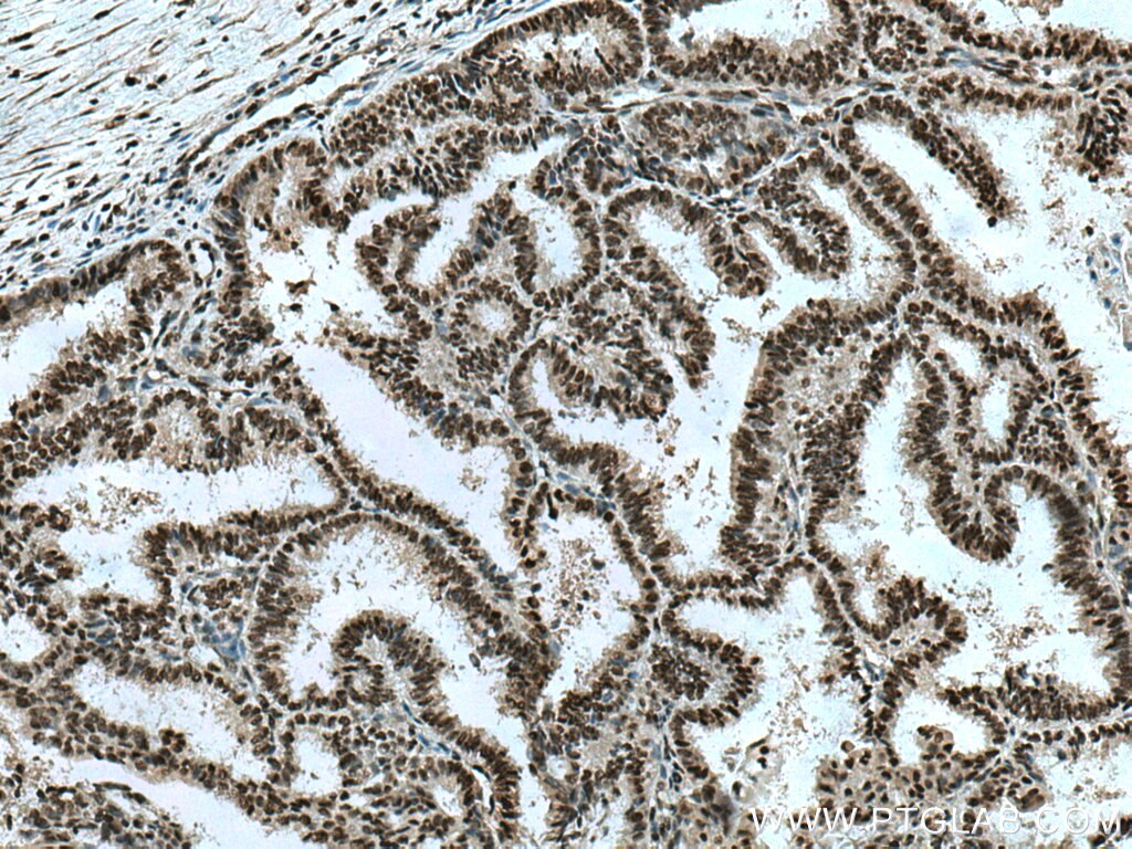 IHC staining of human ovary tumor using 28016-1-AP