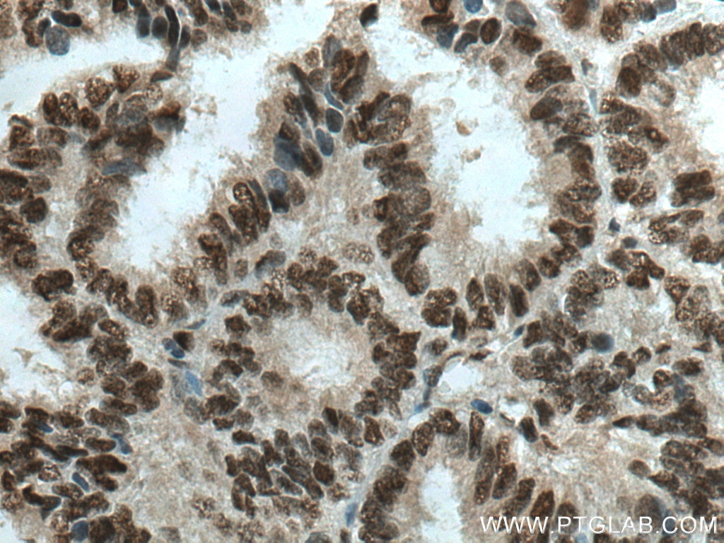 Immunohistochemistry (IHC) staining of human ovary tumor tissue using BPTF Polyclonal antibody (28016-1-AP)