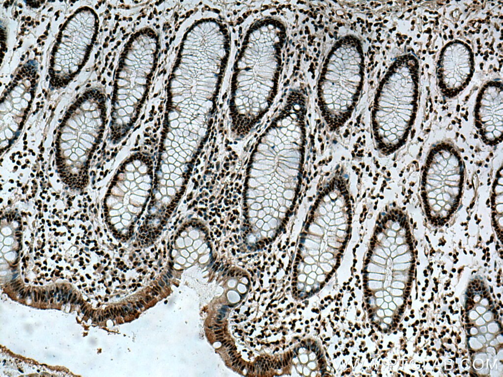 Immunohistochemistry (IHC) staining of human colon cancer tissue using BPTF Polyclonal antibody (28016-1-AP)