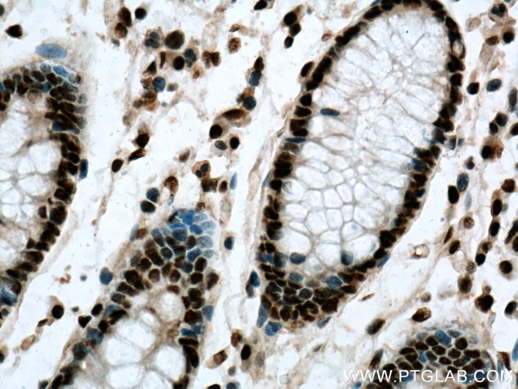 Immunohistochemistry (IHC) staining of human colon cancer tissue using BPTF Polyclonal antibody (28016-1-AP)