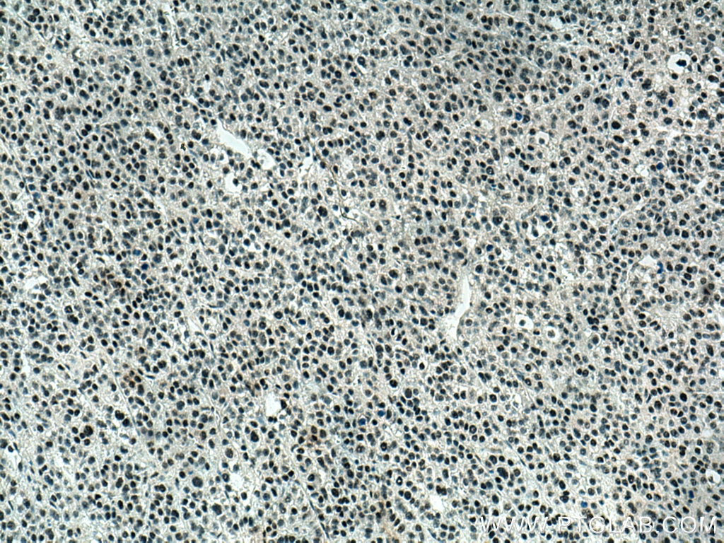 Immunohistochemistry (IHC) staining of human liver cancer tissue using BPTF Polyclonal antibody (28016-1-AP)