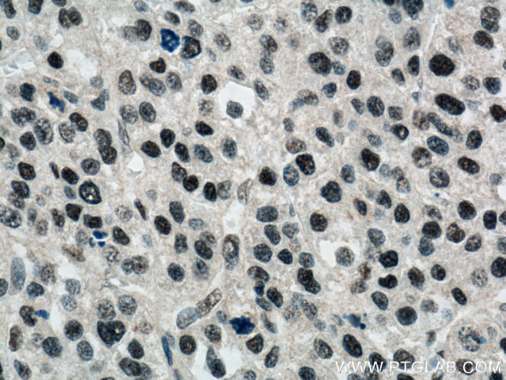 Immunohistochemistry (IHC) staining of human liver cancer tissue using BPTF Polyclonal antibody (28016-1-AP)