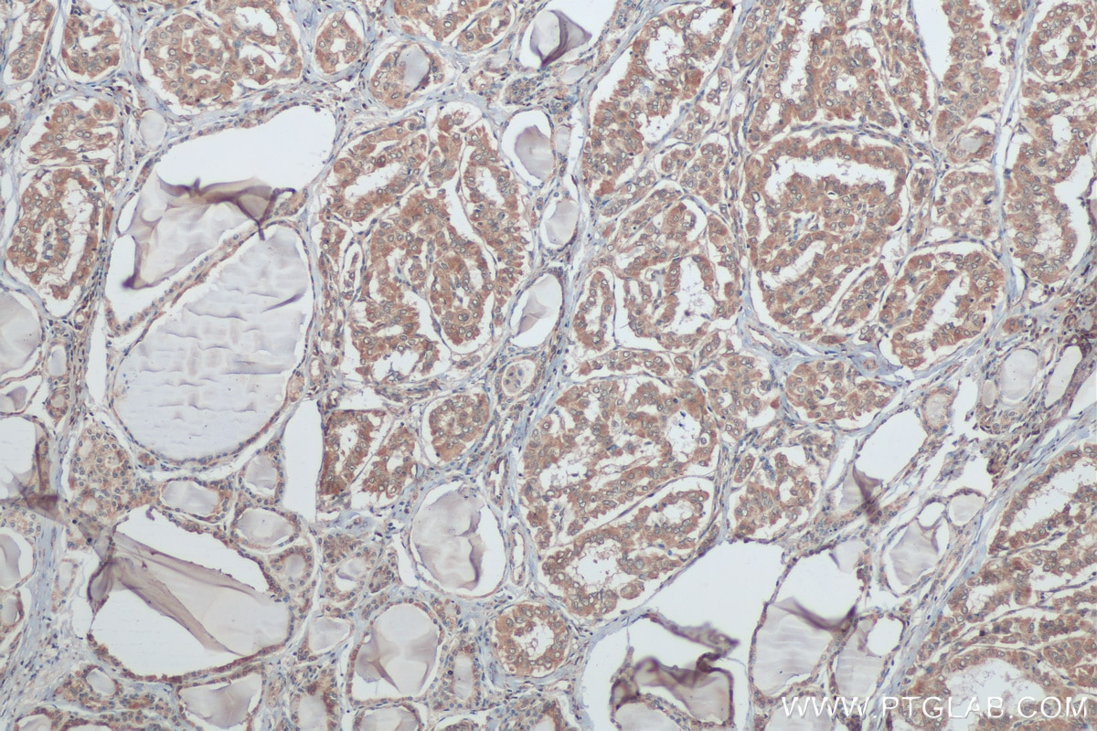 Immunohistochemistry (IHC) staining of human thyroid cancer tissue using BRAF Polyclonal antibody (20899-1-AP)