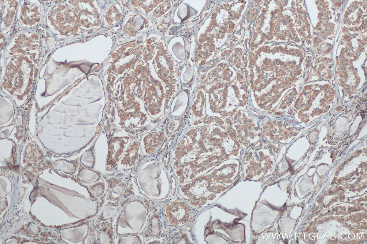 IHC staining of human thyroid cancer using 20899-1-AP