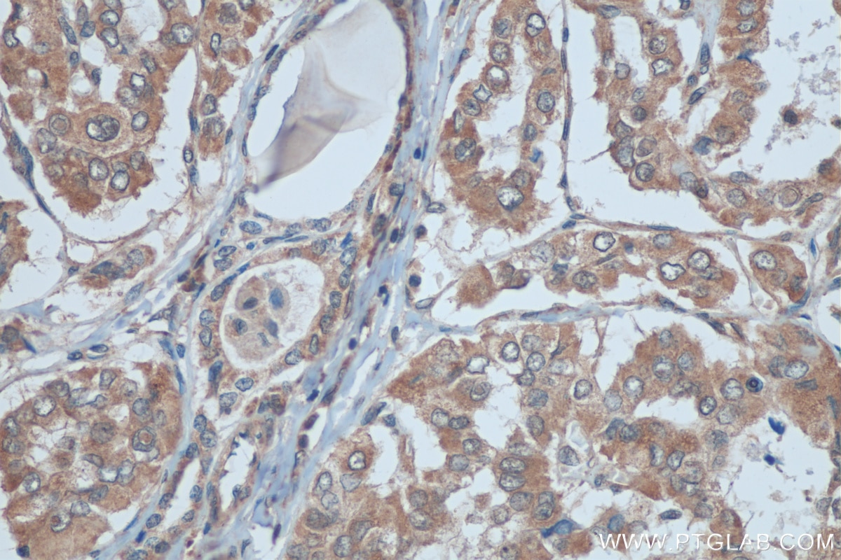 IHC staining of human thyroid cancer using 20899-1-AP