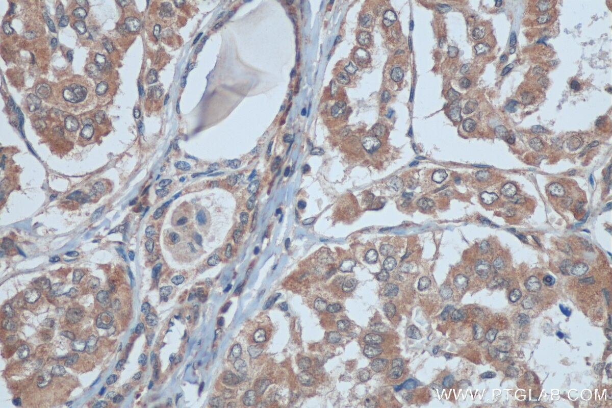 Immunohistochemistry (IHC) staining of human thyroid cancer tissue using BRAF Polyclonal antibody (20899-1-AP)