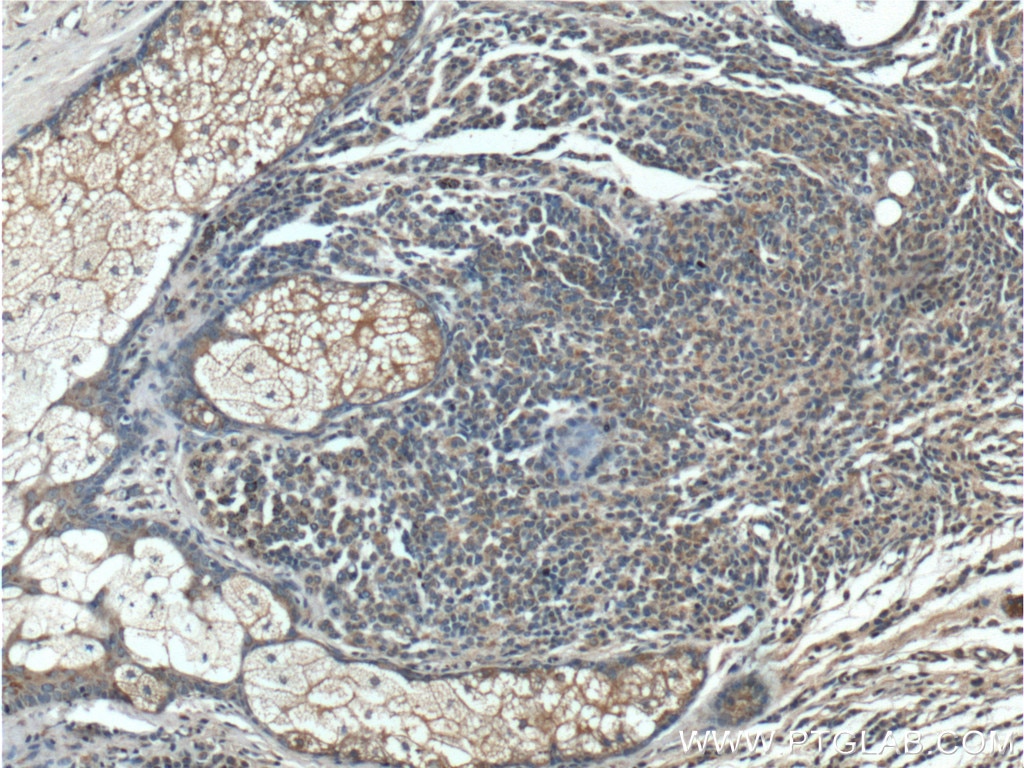 Immunohistochemistry (IHC) staining of human malignant melanoma tissue using BRAF Polyclonal antibody (20899-1-AP)
