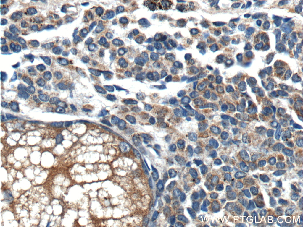 IHC staining of human malignant melanoma using 20899-1-AP