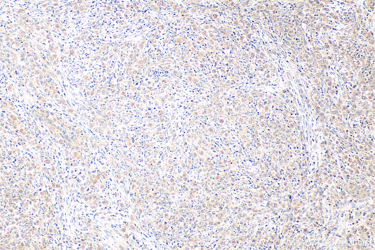 Immunohistochemistry (IHC) staining of human lymphoma tissue using BRAF Polyclonal antibody (20899-1-AP)