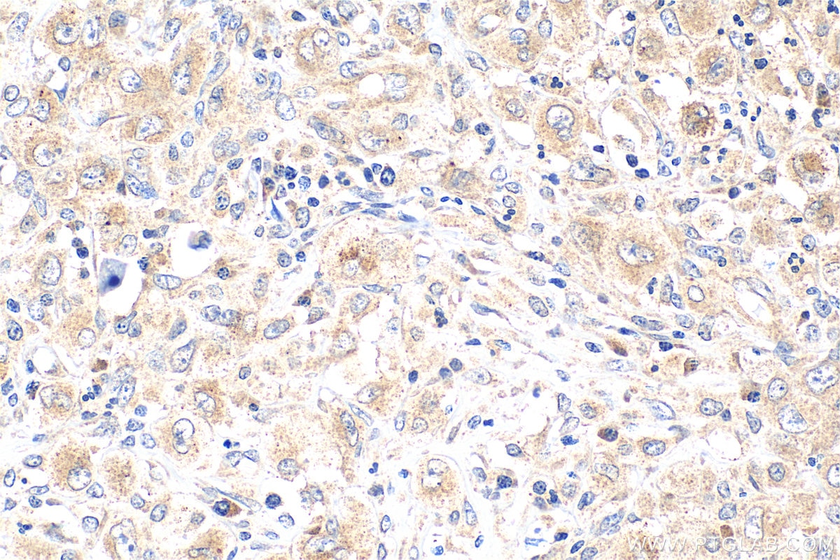 Immunohistochemistry (IHC) staining of human lymphoma tissue using BRAF Polyclonal antibody (20899-1-AP)