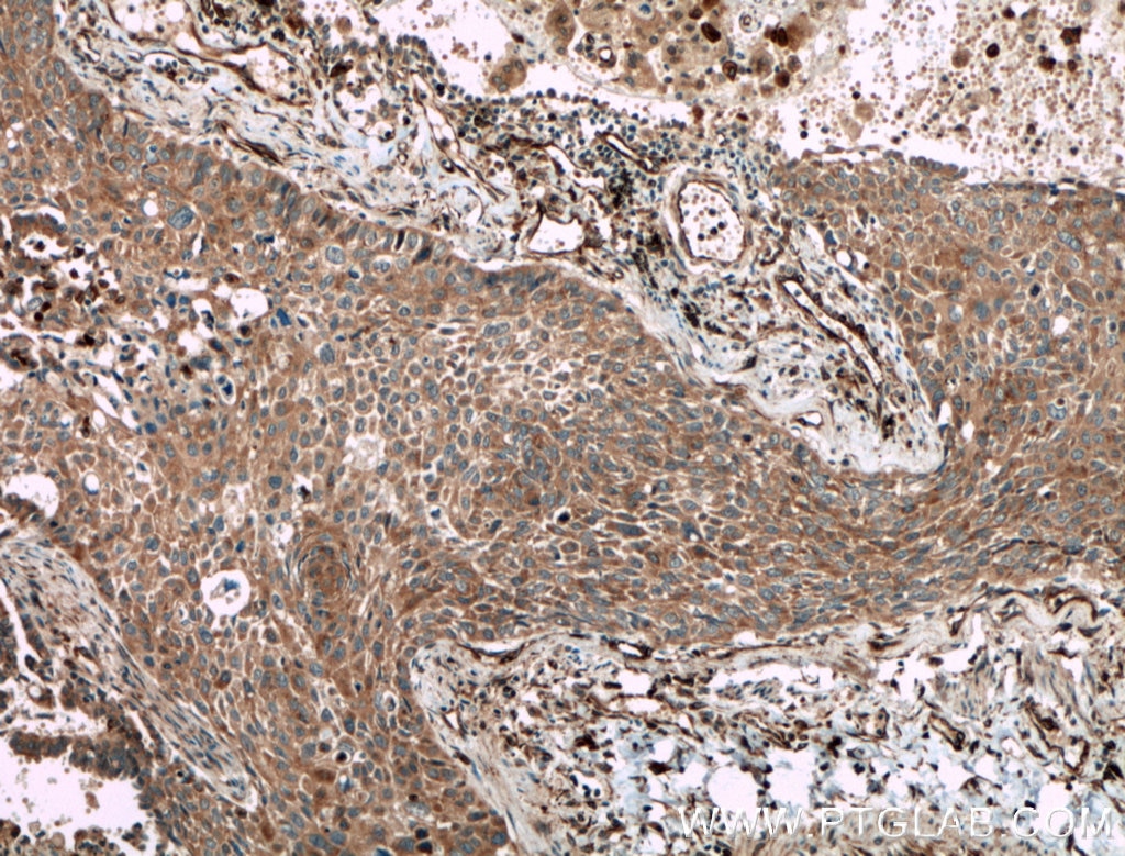 Immunohistochemistry (IHC) staining of human lung cancer tissue using BRAP Polyclonal antibody (27431-1-AP)