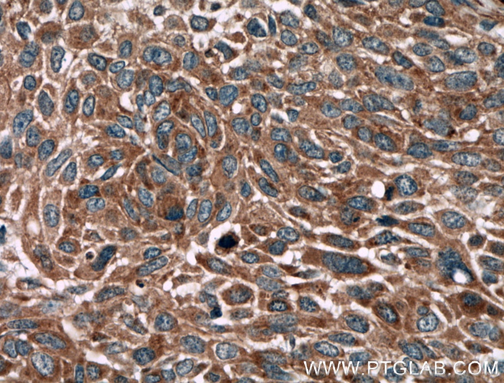 Immunohistochemistry (IHC) staining of human lung cancer tissue using BRAP Polyclonal antibody (27431-1-AP)