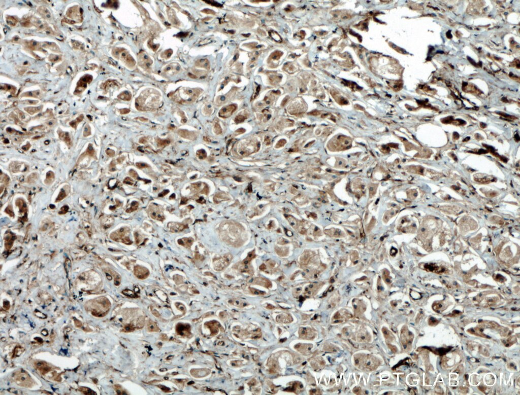 IHC staining of human breast cancer using 27431-1-AP