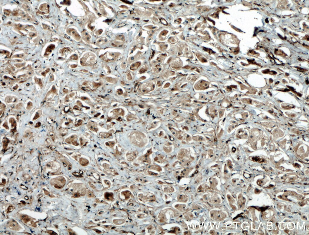 Immunohistochemistry (IHC) staining of human breast cancer tissue using BRAP Polyclonal antibody (27431-1-AP)