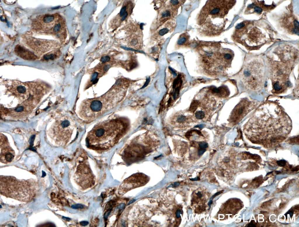 Immunohistochemistry (IHC) staining of human breast cancer tissue using BRAP Polyclonal antibody (27431-1-AP)