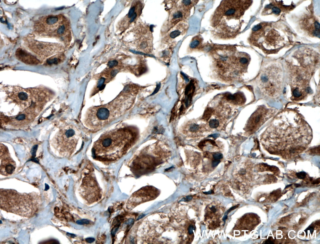 IHC staining of human breast cancer using 27431-1-AP