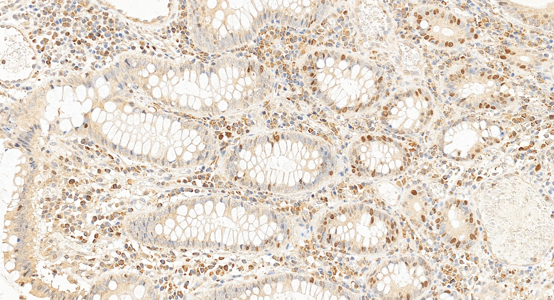 Immunohistochemical analysis of paraffin-embedded human colon cancer tissue slide using 22362-1-AP (BRCA1 antibody) at dilution of 1:1000 (under 20x lens). Heat mediated antigen retrieval with Tris-EDTA buffer (pH 9.0). Immunohistochemistry (IHC) staining of human colon cancer tissue using BRCA1 Polyclonal antibody (22362-1-AP)