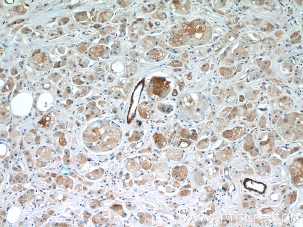 Immunohistochemistry (IHC) staining of human breast cancer tissue using BRCA1 Polyclonal antibody (22362-1-AP)
