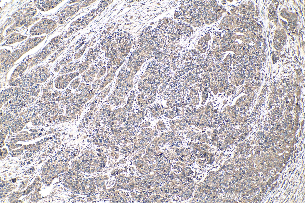 Immunohistochemistry (IHC) staining of human ovary tumor tissue using BRCA1 Polyclonal antibody (22362-1-AP)