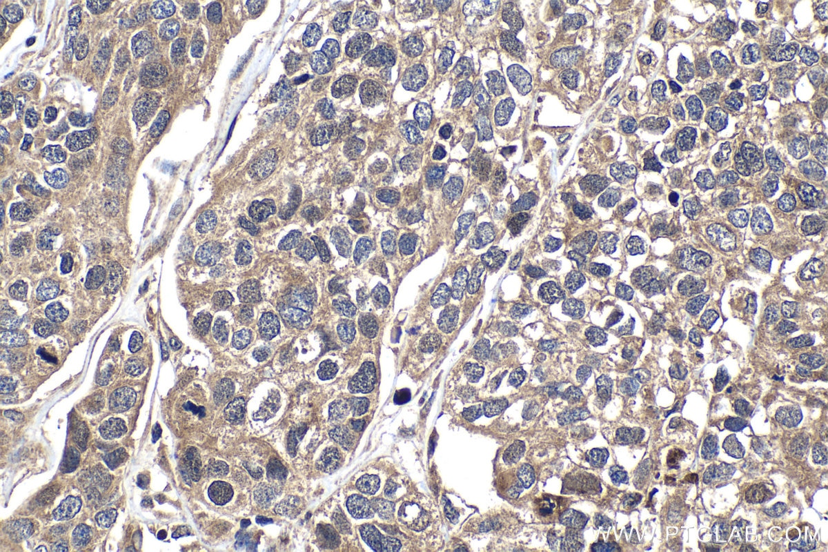 Immunohistochemistry (IHC) staining of human ovary tumor tissue using BRCA1 Polyclonal antibody (22362-1-AP)