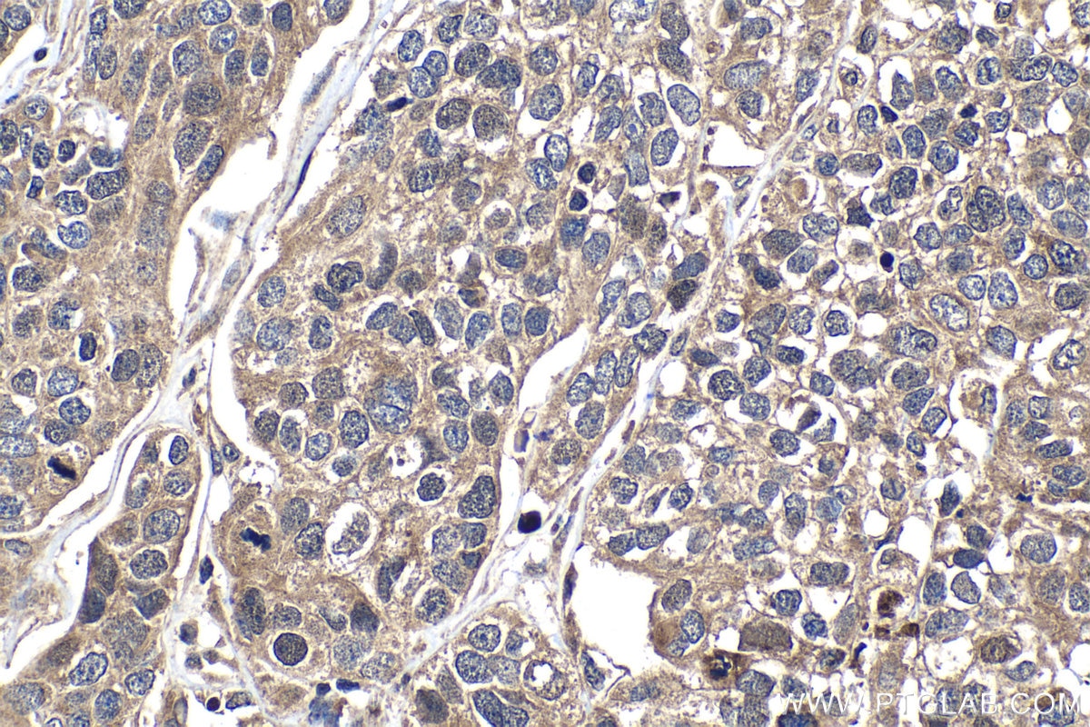 IHC staining of human ovary tumor using 22362-1-AP